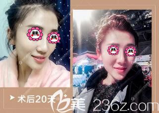 做完鼻整形術(shù)后20天恢復(fù)效果圖 做完鼻整形術(shù)后20天恢復(fù)效果圖