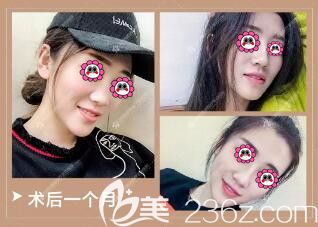 在百嘉麗做完鼻整形術(shù)后30天恢復(fù)效果圖 在百嘉麗做完鼻整形術(shù)后30天恢復(fù)效果圖