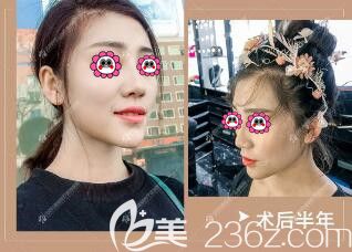 在沈陽百嘉麗做超體+自體軟骨隆鼻術(shù)后半年效果圖 在沈陽百嘉麗做超體+自體軟骨隆鼻術(shù)后半年效果圖