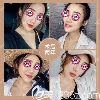 看兩年前在沈陽(yáng)百嘉麗做超體+自體軟骨隆鼻的小姐姐現(xiàn)在竟然變成這樣了！