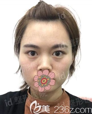 韓國id整形術前 韓國id整形術前