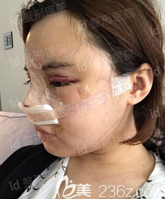 韓國id面部輪廓整形 韓國id面部輪廓整形