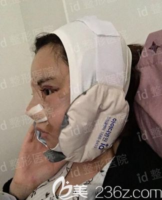 韓國id面部輪廓整形術后第2天 韓國id面部輪廓整形術后第2天