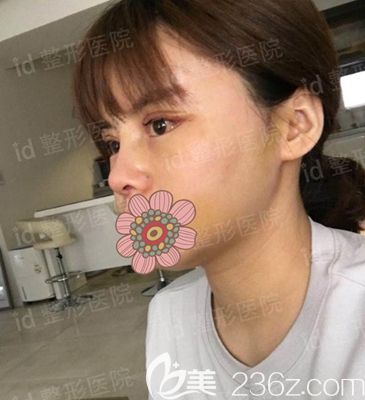 韓國id面部輪廓整形術后1個月 韓國id面部輪廓整形術后1個月