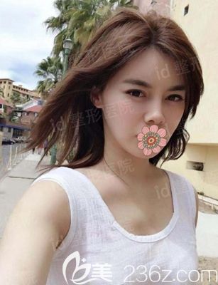 韓國id面部輪廓整形術后9個月 韓國id面部輪廓整形術后9個月