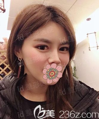 韓國id面部輪廓整形術后10個月 韓國id面部輪廓整形術后10個月