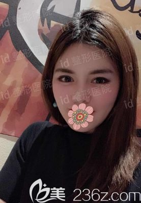 韓國id面部輪廓整形術后12個月 韓國id面部輪廓整形術后12個月