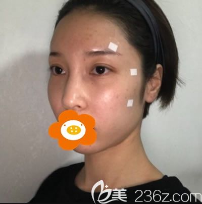 術(shù)后3天效果