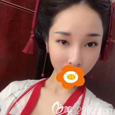 做自體脂肪全臉填充15天拍的寫(xiě)真