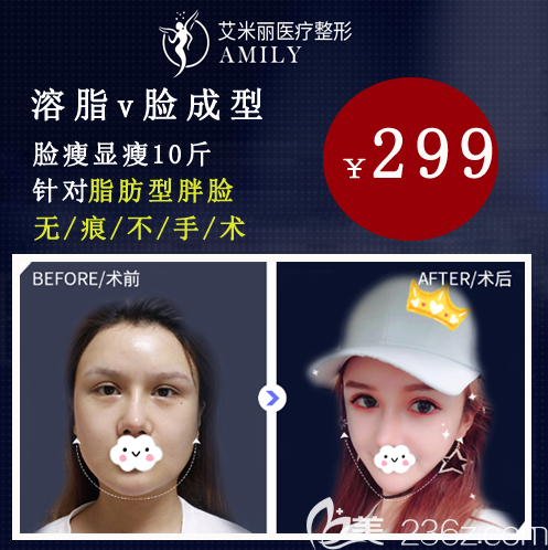 成都艾米麗10周年元起V臉溶脂299元起