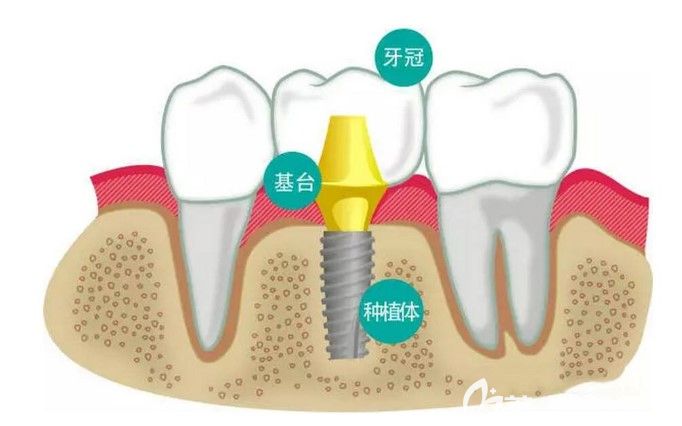 張立醫(yī)生解析:拔牙沒補(bǔ)七八年還能種牙嗎 張立醫(yī)生解析:拔牙沒補(bǔ)七八年還能種牙嗎