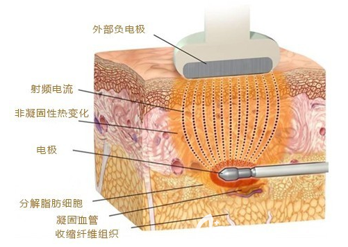 射頻溶脂原來示意圖