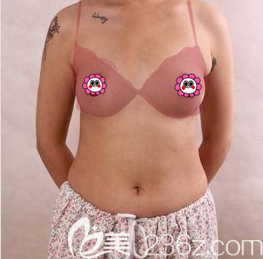 我在北京美萊做自體脂肪豐胸前樣子 我在北京美萊做自體脂肪豐胸前樣子