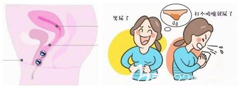 陰道壁膨出的危害