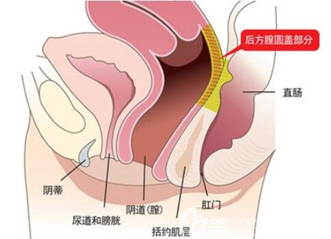 韓國好手藝后方膣圓蓋術(shù)