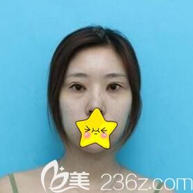 做雙眼皮術(shù)前照 做雙眼皮術(shù)前照