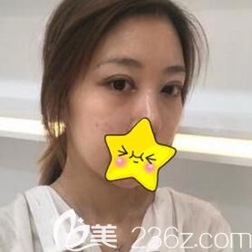 在沈陽騰采做雙眼皮術(shù)后一周拆線 在沈陽騰采做雙眼皮術(shù)后一周拆線