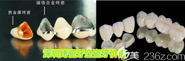深圳烤瓷牙和全瓷牙價格