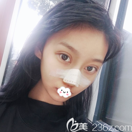 隆鼻術(shù)后4天恢復(fù)<span style= 隆鼻術(shù)后4天恢復(fù)<span style=