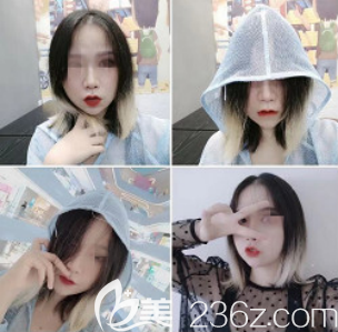 濟(jì)南美蓮真的是一家正規(guī)的醫(yī)院，看我在美蓮做的玻尿酸填充下巴手術(shù)就知道了