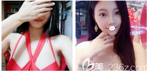 快看廣州美恩醫(yī)院許揚濱做隆胸怎么樣 快看廣州美恩醫(yī)院許揚濱做隆胸怎么樣