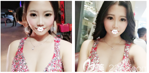 許揚濱自體脂肪隆胸術(shù)后一個月案例 許揚濱自體脂肪隆胸術(shù)后一個月案例