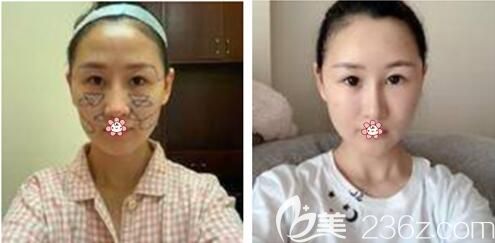 手術(shù)后兩天的樣子 手術(shù)后兩天的樣子