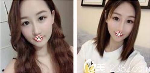 20天效果已經(jīng)挺明顯了 20天效果已經(jīng)挺明顯了