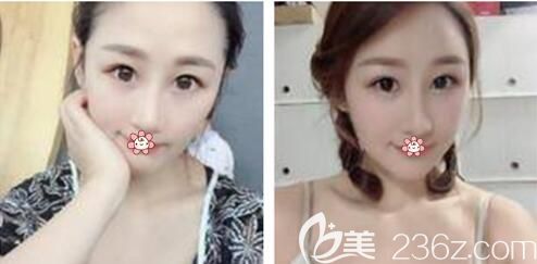 重慶美萊做脂肪填充手術(shù)怎么樣 重慶美萊做脂肪填充手術(shù)怎么樣