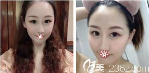 重慶美萊哪個(gè)醫(yī)生做脂肪填充好 重慶美萊哪個(gè)醫(yī)生做脂肪填充好