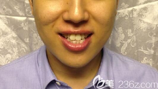 牙齒擁擠在北京佳美口腔做矯正前的照片 牙齒擁擠在北京佳美口腔做矯正前的照片