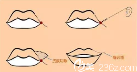 韓國原辰嘴角上揚術(shù)讓笑容變的甜美
