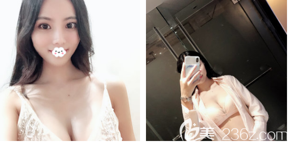 看深圳非凡整形醫(yī)院隆胸效果怎么樣 看深圳非凡整形醫(yī)院隆胸效果怎么樣