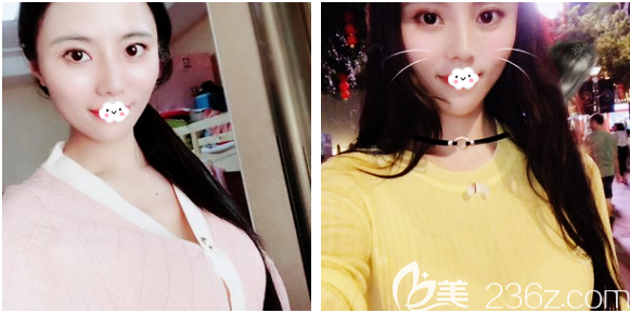 深圳非凡假體隆胸案例7天效果圖 深圳非凡假體隆胸案例7天效果圖