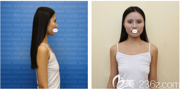 感覺身邊去深圳非凡隆胸的人挺多的于是我也慕名找梅夠明做了娜綺麗假體隆胸 感覺身邊去深圳非凡隆胸的人挺多的于是我也慕名找梅夠明做了娜綺麗假體隆胸