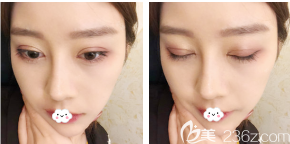 找廣州曙光王娟做完雙眼皮半個月了 找廣州曙光王娟做完雙眼皮半個月了