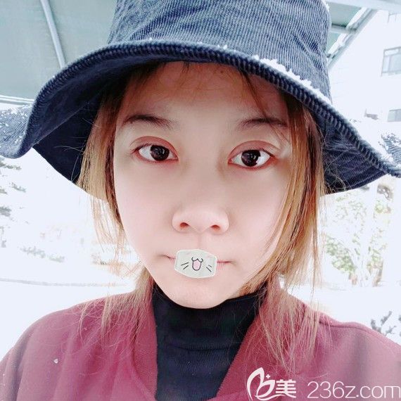 荊州華美雙眼皮修復(fù)術(shù)后一周恢復(fù)圖