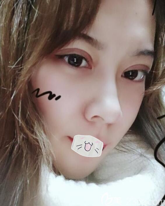 荊州華美眼部修復(fù)整形手術(shù)案例恢復(fù)過程圖