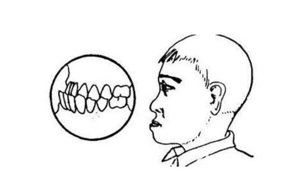 我老公牙齒地包天圖片