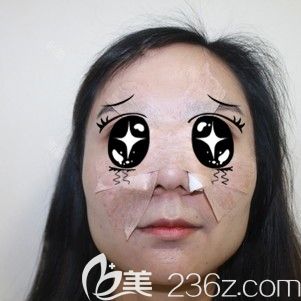 做鼻翼縮小整形術(shù)后即刻被包裹嚴(yán)實的自己 做鼻翼縮小整形術(shù)后即刻被包裹嚴(yán)實的自己