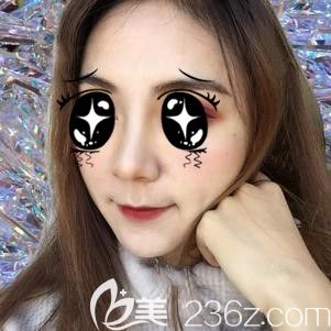 張主任幫我做鼻翼縮小術(shù)后30天鼻子消腫 張主任幫我做鼻翼縮小術(shù)后30天鼻子消腫