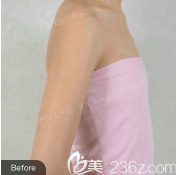 我在北京美萊做傲諾拉假體隆胸前樣子 我在北京美萊做傲諾拉假體隆胸前樣子