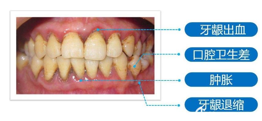 馬建民院長解析：為什么有牙周病不能進行種植牙