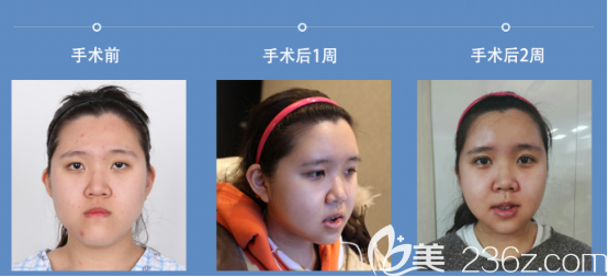 術(shù)后兩周 術(shù)后兩周