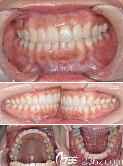 來(lái)看看隱適美正畸效果 來(lái)看看隱適美正畸效果