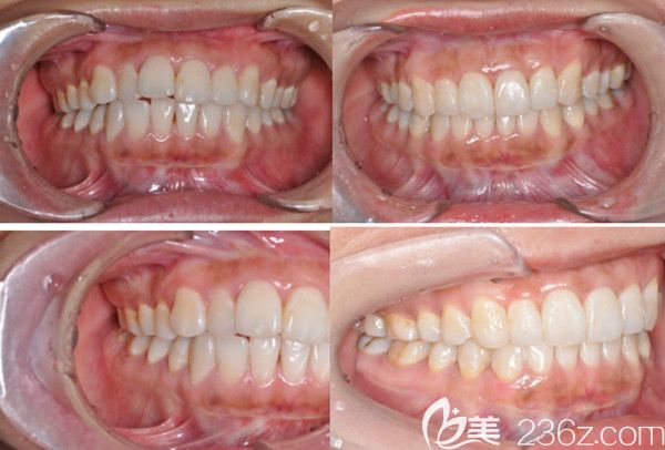 隱適美矯正前后效果圖 隱適美矯正前后效果圖