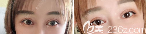 眼修復(fù)手術(shù)一個(gè)月初步看到效果 眼修復(fù)手術(shù)一個(gè)月初步看到效果