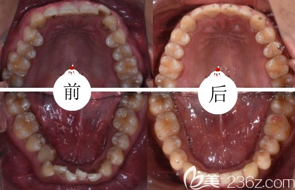 隱適美隱形牙套矯正效果如何 隱適美隱形牙套矯正效果如何