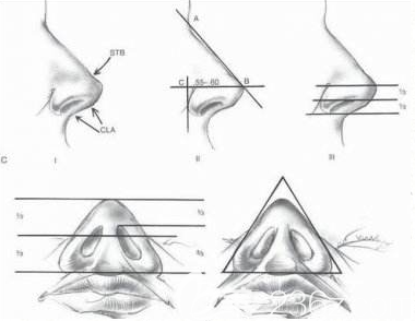 韓國(guó)清潭FIRST體旋翼鼻修復(fù)拯救做失敗鼻子
