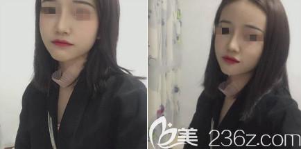 煙臺華怡是一家正規(guī)的整形醫(yī)院，看我在煙臺華怡做的耳軟骨+膨體隆鼻手術